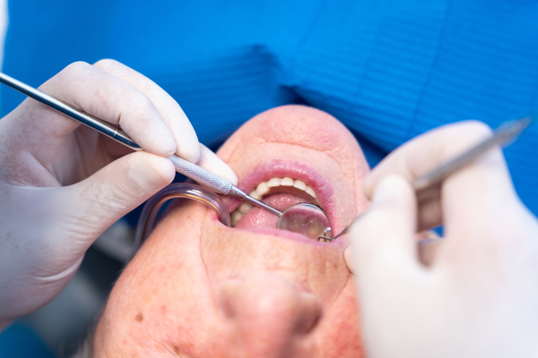 What To Know About Dental Filling Material Options